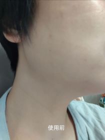 Adrian-JOSERISTINE 彩豐皮奧寧祛痘．淡疤去印修復膏_3