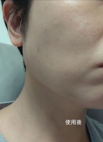 Adrian-JOSERISTINE 彩豐皮奧寧祛痘．淡疤去印修復膏_4