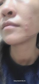 Niki Yau-JOSERISTINE 彩豐皮奧寧祛痘．強效消炎膏_2