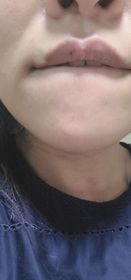 Niki Yau-JOSERISTINE 彩豐皮奧寧祛痘．強效消炎膏_3