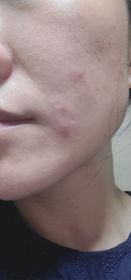 Niki Yau-JOSERISTINE 彩豐皮奧寧祛痘．強效消炎膏_4