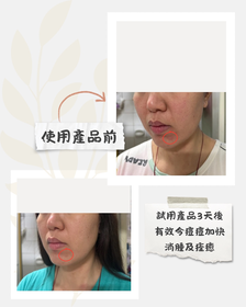 mandyf128-JOSERISTINE 彩豐皮奧寧祛痘.強效消炎膏_2