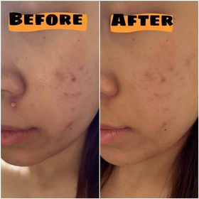 Coyee C.-JOSERISTINE 彩豐皮奧寧祛痘．強效消炎膏_4