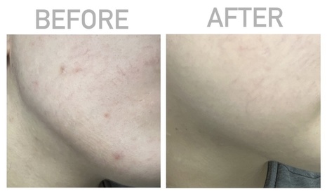 bbbcls-JOSERISTINE 彩豐皮奧寧祛痘．強效消炎膏_1