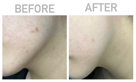 bbbcls-JOSERISTINE 彩豐皮奧寧祛痘．淡疤去印修復膏_1