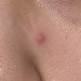 nahyee-JOSERISTINE 彩豐皮奧寧祛痘．強效消炎膏_1