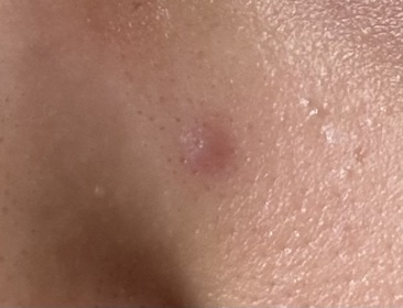 nahyee-JOSERISTINE 彩豐皮奧寧祛痘．強效消炎膏_2