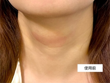 alice-Atorrege AD+速效保濕噴霧_2