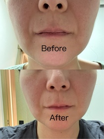 Phoebe-Atorrege AD+深層保濕精華 (水繃帶)_1