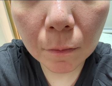 Phoebe-Atorrege AD+速效保濕噴霧_1