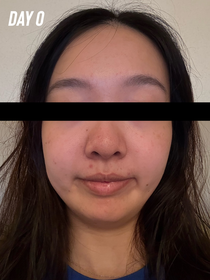 Kmggigi-Atorrege AD+深層保濕精華 (水繃帶)_3