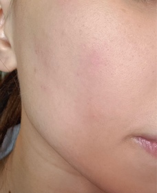 Kaori To-Atorrege AD+深層保濕精華 (水繃帶)_4