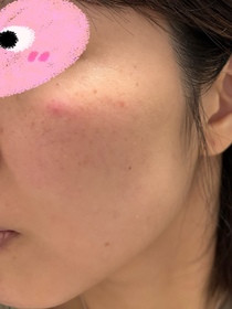 jodidii-Atorrege AD+深層保濕精華 (水繃帶)_3