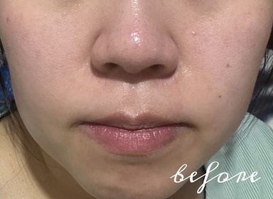 chingggc-Atorrege AD+深層保濕精華 (水繃帶)_1