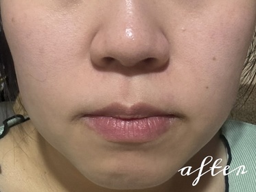 chingggc-Atorrege AD+深層保濕精華 (水繃帶)_2