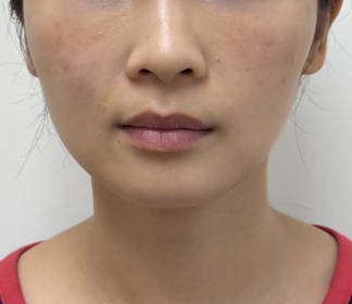 Judy-麗珠蘭 REJURANPDRx 5%超水光深層保濕再生修復面膜_1