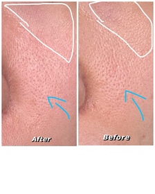 東區蘇牙琳-CeraVeSA水楊酸煥膚潔膚露_3