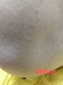 Anna-AHC醫美科研水光導入玻尿酸精華 #水光微整精華_1