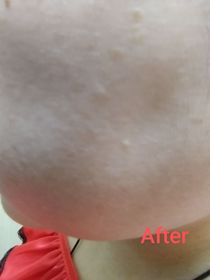 Anna-AHC醫美科研水光導入玻尿酸精華 #水光微整精華_2