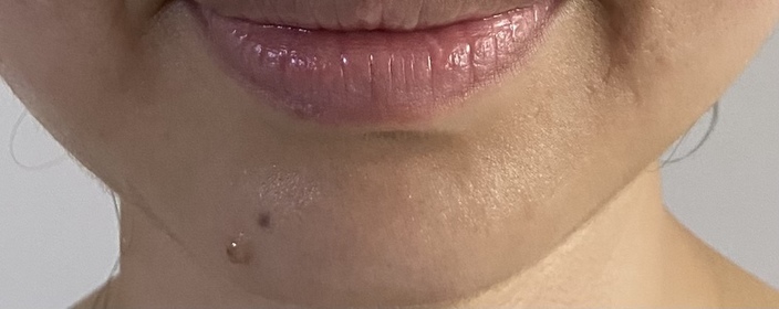 Candy Ng-AHC醫美科研水光導入玻尿酸精華 #水光微整精華_1