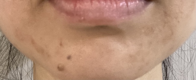 Candy Ng-AHC醫美科研水光導入玻尿酸精華 #水光微整精華_2