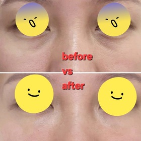 Fng-AHC醫美科研水光導入玻尿酸全臉眼霜 #水光微整全臉眼霜_3