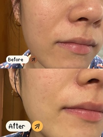 Bchonfrise -DECORTÉWHITELOGIST 麴酸速效美白精華面膜_1