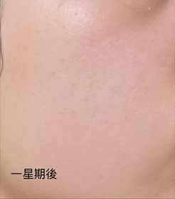 Choi-Curél碳酸泡沫精華_4