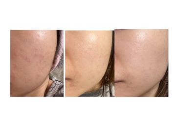 chasiutung-SHISEIDO 資生堂ULTIMUNE皇牌免疫力活膚精華_3