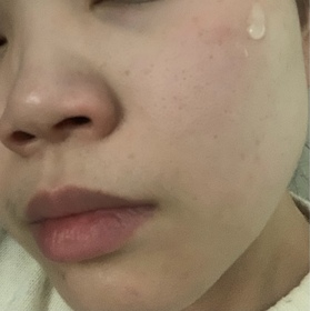 Emma W-AHC醫美科研水光導入玻尿酸精華 #水光微整精華_1