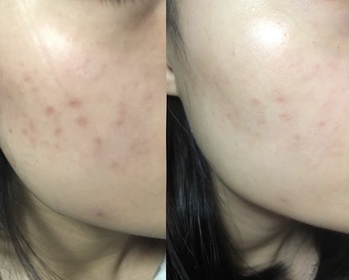 Emily Leung-DR.WU杏仁酸溫和煥膚精華8% _4
