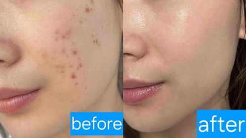 Fng-JOSERISTINE 彩豐皮奧寧祛痘．強效消炎膏_4