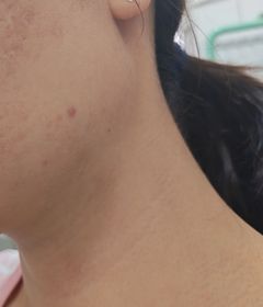 Yumi0149-JOSERISTINE 彩豐皮奧寧祛痘.強效消炎膏_3