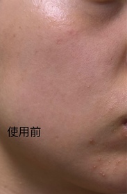 Choi-JOSERISTINE 彩豐皮奧寧祛痘.強效消炎膏_2
