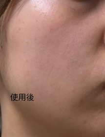 Choi-JOSERISTINE 彩豐皮奧寧祛痘.強效消炎膏_3