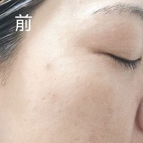 Erica -L'ORÉAL PARiS超水光精華_1